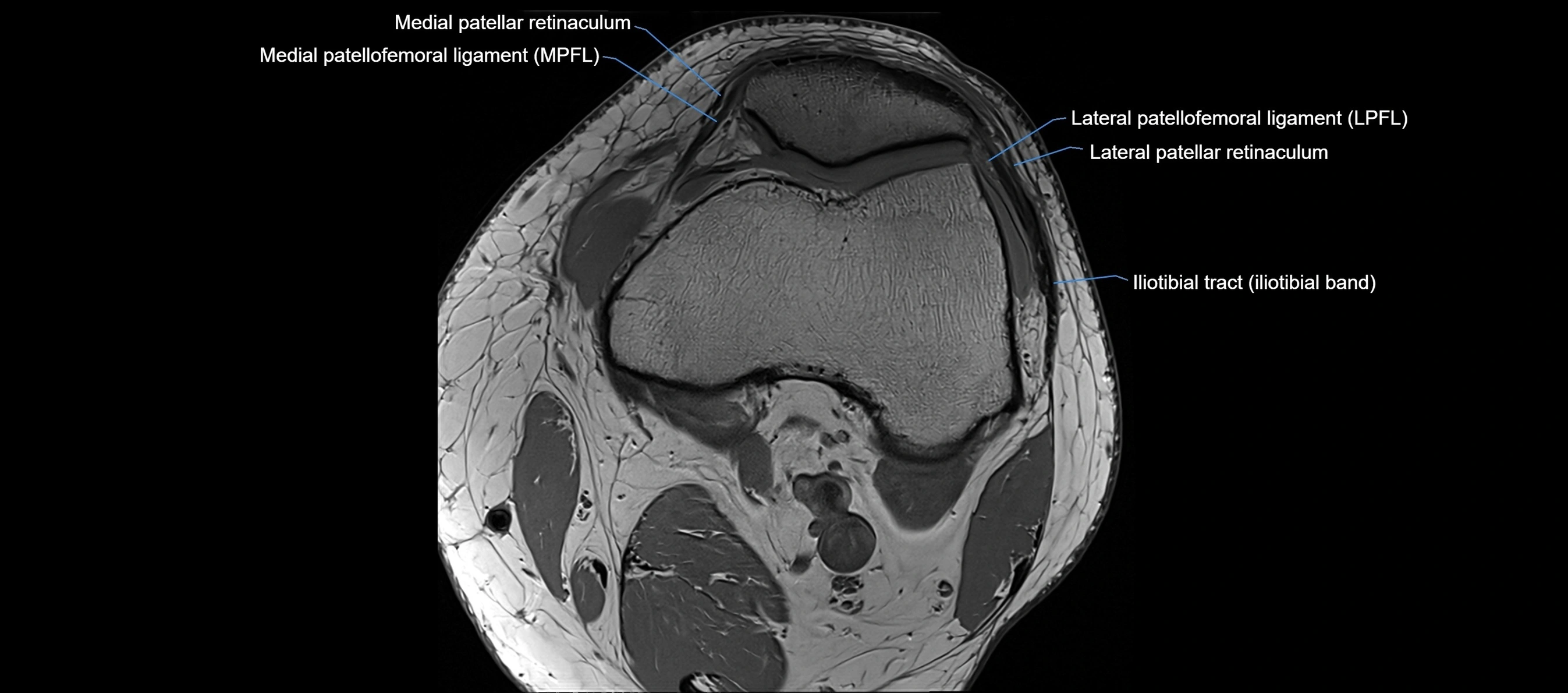 MRI Knee axial  ligaments cross sectional anatomy 3T  radiology  image-img-03001-00015.webp